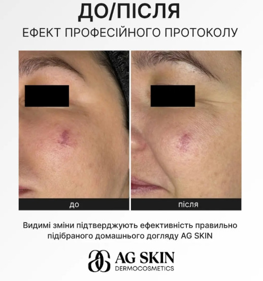 СУДИНОЗМІЦНЮЮЧА СИРОВАТКА AG SKIN ANTI-REDNESS SERUM, 30 мл