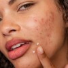 Гель-крем для лечения пятен после высыпаний Dermalogica - Clear Start Post Breakout Fix 15 мл