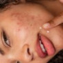 Гель-крем для лечения пятен после высыпаний Dermalogica - Clear Start Post Breakout Fix 15 мл